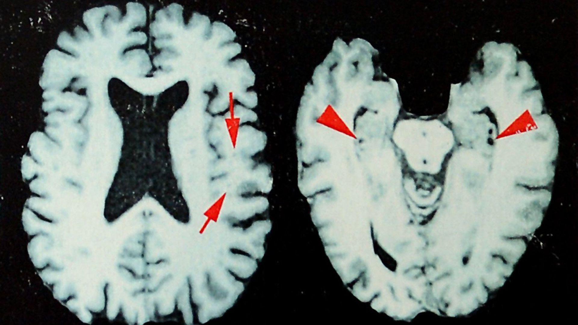 Dead NFL Players May Have 97% Chance of Brain Disease, New Study Says